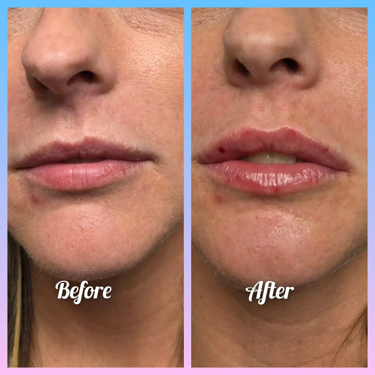 Side-by-side before-and-after comparison from an individual lip enhancement treatment