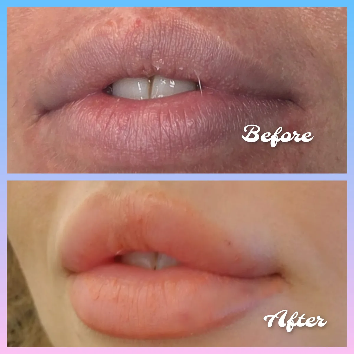 Lip filler volume and definition treatment results from Nimue Aesthetics