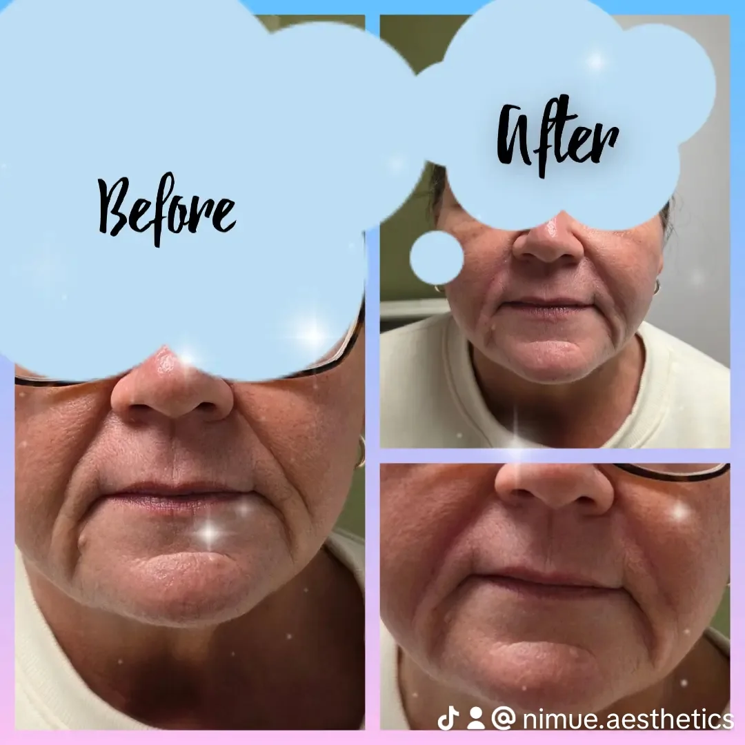 Before-and-after comparison from an individual lines and folds treatment