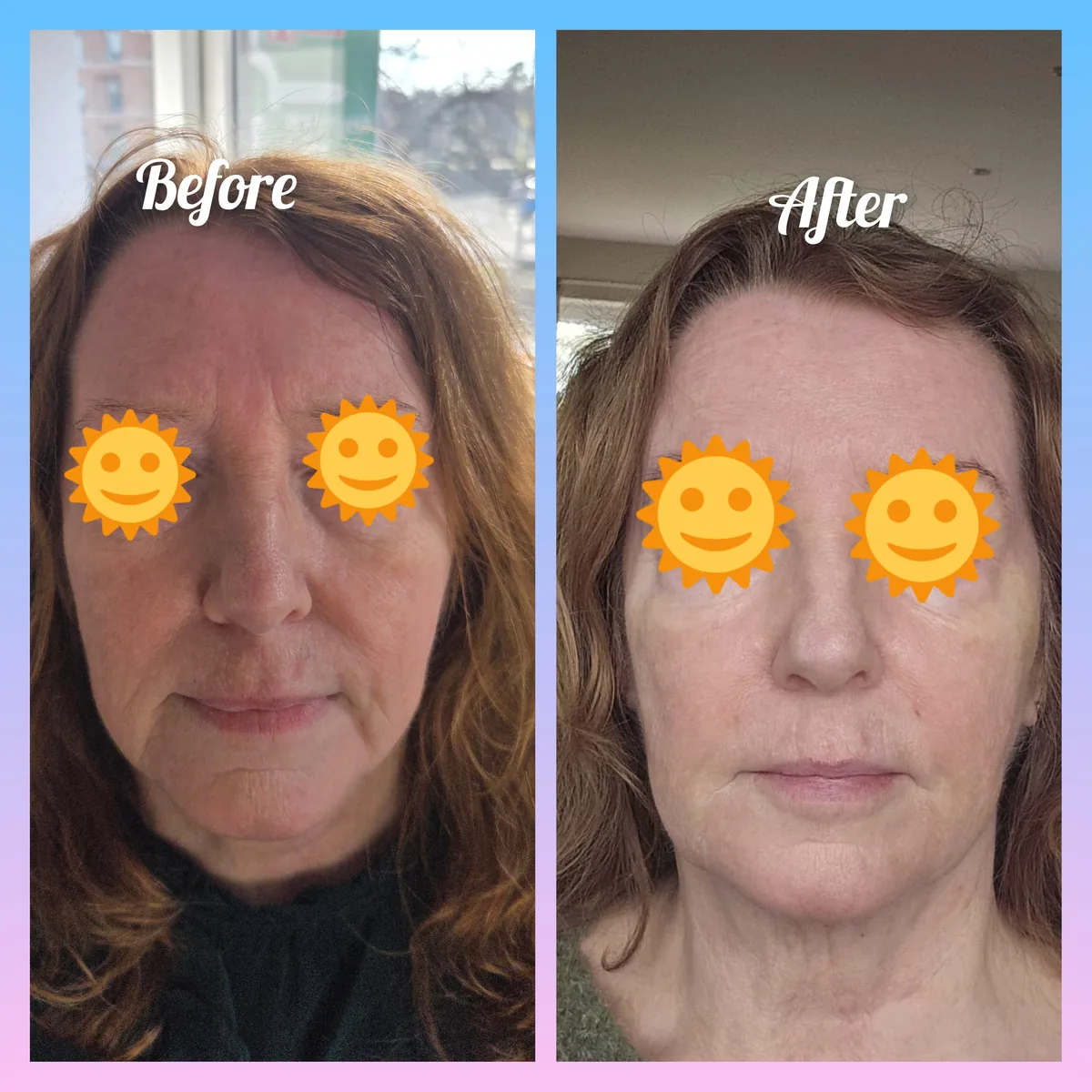 Side-by-side before-and-after comparison from an individual facial lines treatment