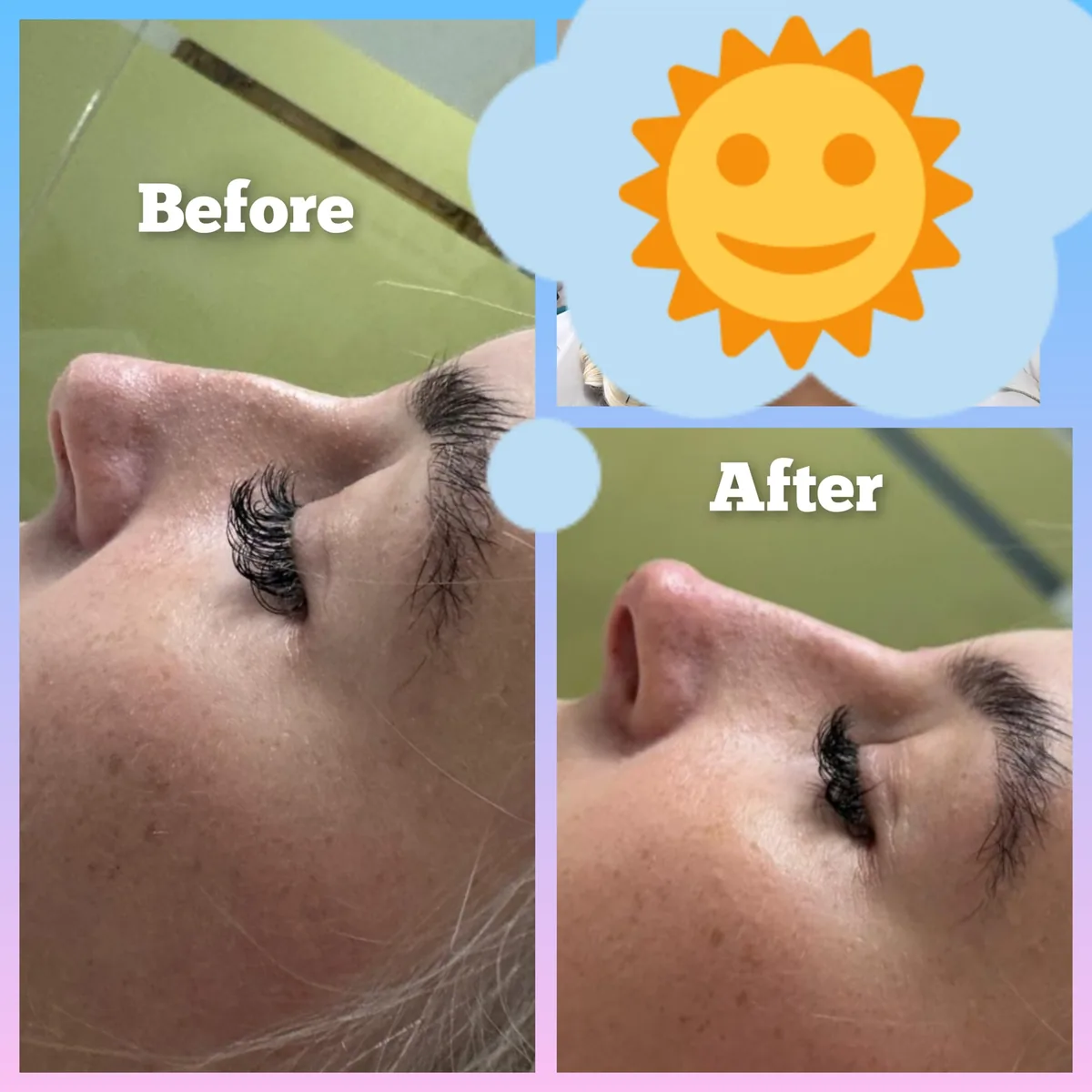 Profile before-and-after comparison from an individual non-surgical rhinoplasty treatment