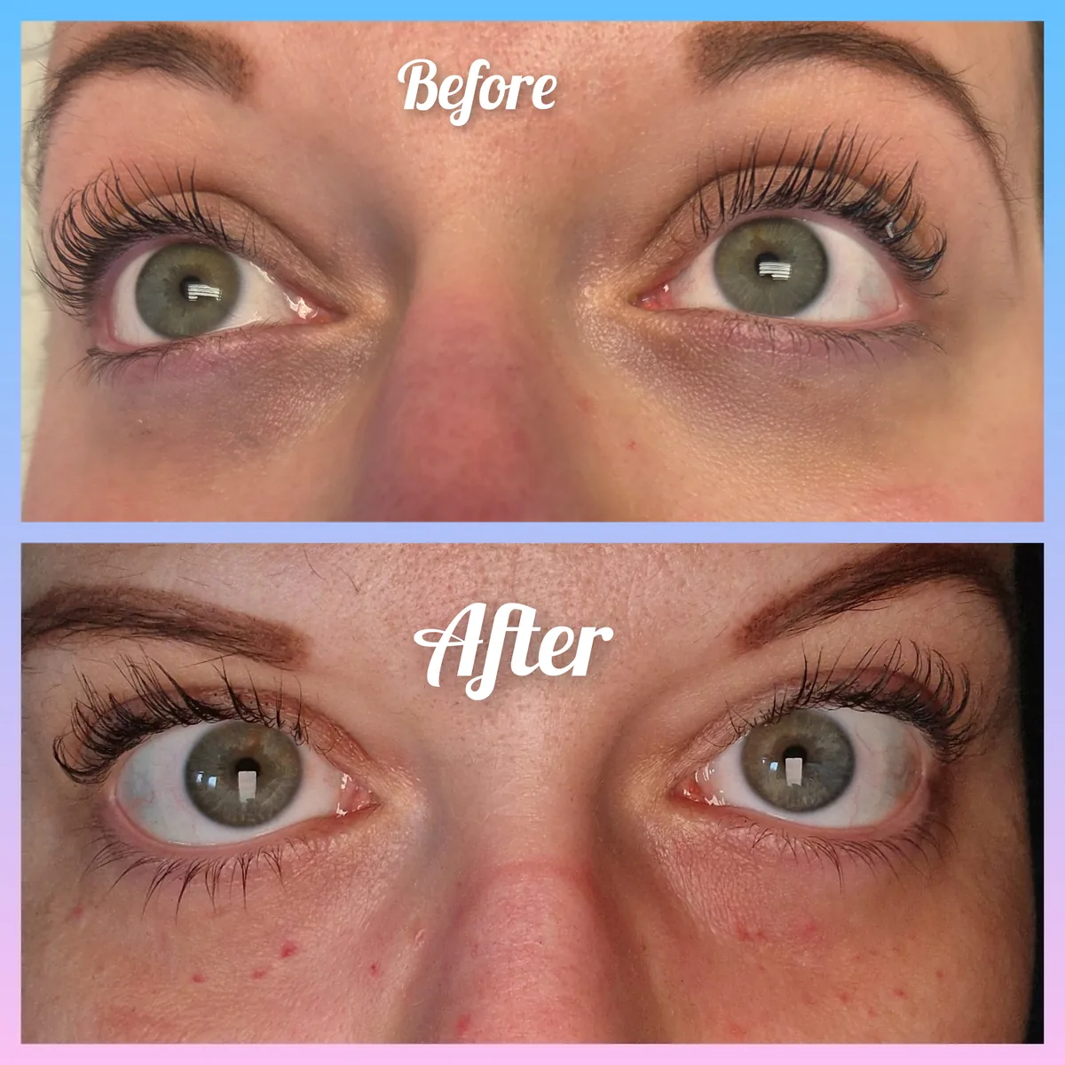 Skin booster treatment results from Nimue Aesthetics